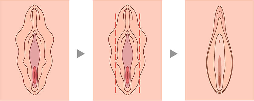 cirurgia íntima feminina antes e depois