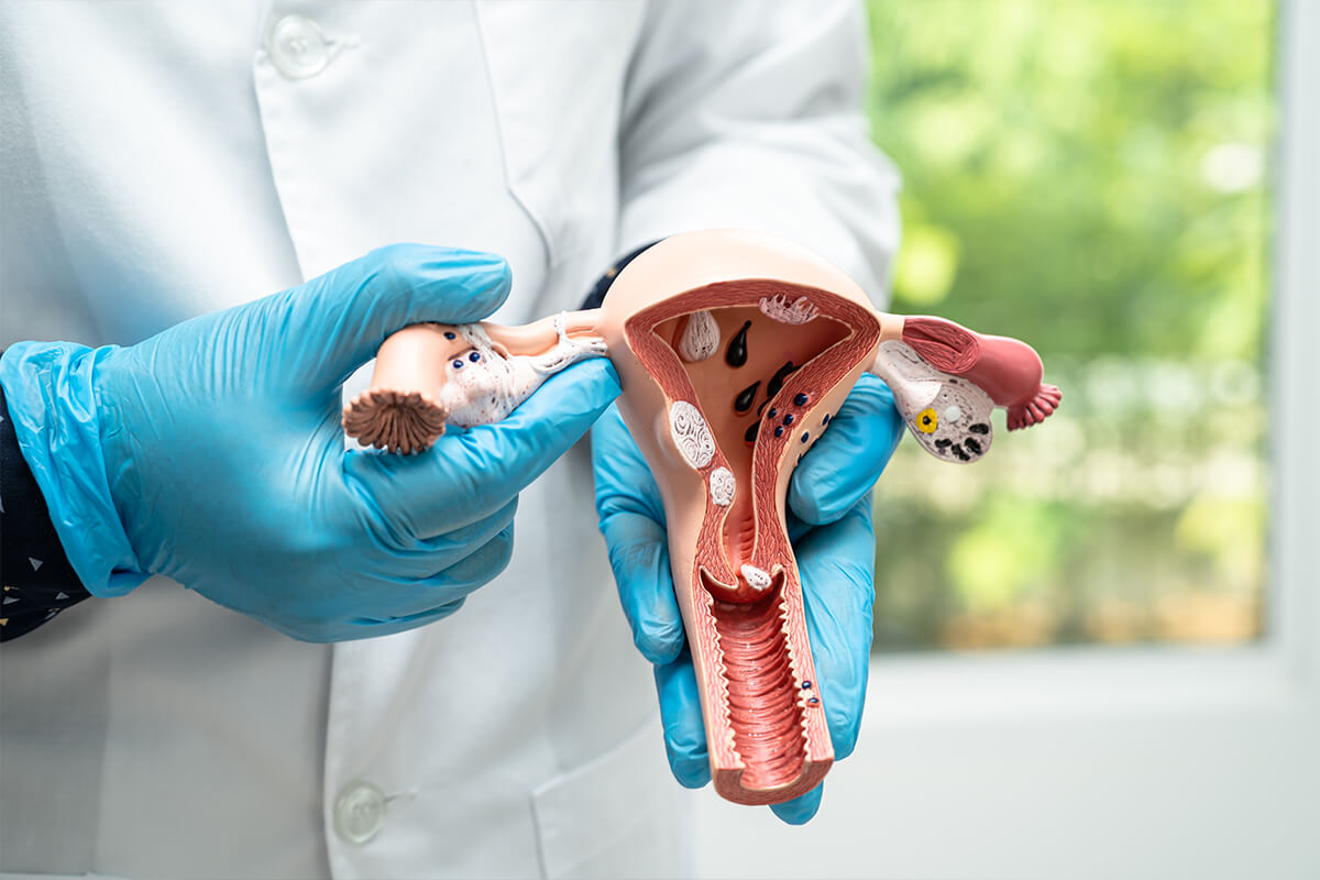 Videolaparoscopia Para Endometriose