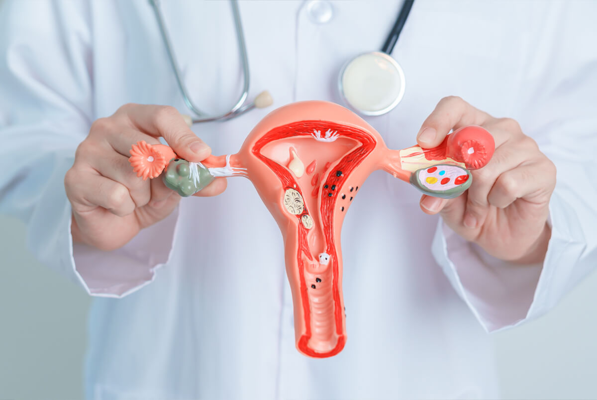 Sintomas de Miomas Uterinos